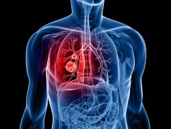 Pharma Plans Route to Non-Small Cell Lung Cancer Success
